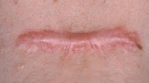 Mọi điều cần biết về sẹo lồi Unknown 1 6