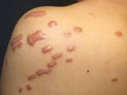 Mọi điều cần biết về sẹo lồi Unknown 13