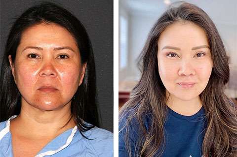 Tất tần tật về Căng chỉ best asian facelift results nyc