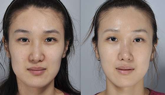 Tất tần tật về Căng chỉ mint before after 004 facelift threads sutures bioscor melbourne australia face lift sagging skin jowls heavy cheeks