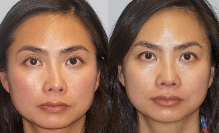 Sửa lại mũi đã phẫu thuật | Viện thẩm mỹ SaigonSeoul – Ths. Bs Nguyễn Ngọc Nhơn The Woodlands Plastic Surgery Gallery Rhinoplasty Nose Job Texas RH1010 Front View 01 768x468 1
