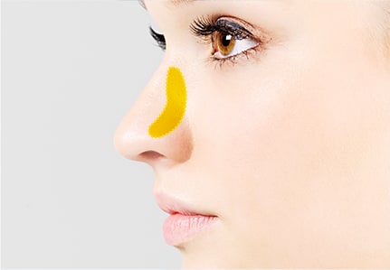 Hiểu hơn về nâng mũi sụn tự thân cùng Ths. Bs Nguyễn Ngọc Nhơn autologous cartilage rhinoplasty types 02