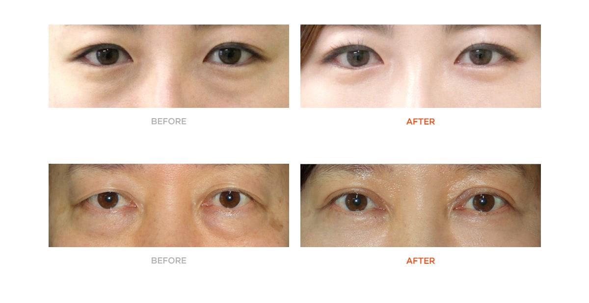 Cắt mí dưới – Ths. Bs Nguyễn Ngọc Nhơn lower eyelid surgery gallery