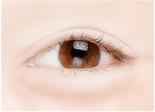 Cắt mí dưới – Ths. Bs Nguyễn Ngọc Nhơn lower eyelid surgery method 01.jpg