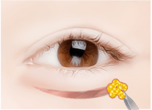 Cắt mí dưới – Ths. Bs Nguyễn Ngọc Nhơn lower eyelid surgery method 02.jpg