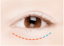 Cắt mí dưới – Ths. Bs Nguyễn Ngọc Nhơn lower eyelid surgery method 03.jpg