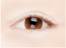 Cắt mí dưới – Ths. Bs Nguyễn Ngọc Nhơn lower eyelid surgery method 04.jpg