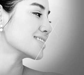 Phân tích 360 độ về dáng mũi thường gặp của người Châu Á | Ths. Bs Nguyễn Ngọc Nhơn nose surgery by type conditions 03