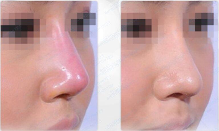 Sửa lại mũi đã phẫu thuật | Viện thẩm mỹ SaigonSeoul – Ths. Bs Nguyễn Ngọc Nhơn qua cao2 768x460 1
