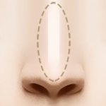 Sửa lại mũi đã phẫu thuật | Viện thẩm mỹ SaigonSeoul – Ths. Bs Nguyễn Ngọc Nhơn revision rhinoplasty doctors 02