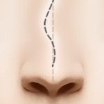 Sửa lại mũi đã phẫu thuật | Viện thẩm mỹ SaigonSeoul – Ths. Bs Nguyễn Ngọc Nhơn revision rhinoplasty doctors 03