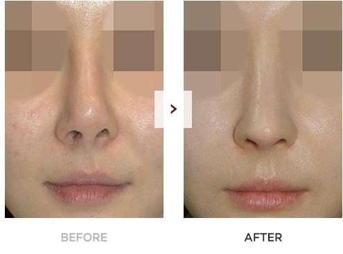 Phẫu thuật xử lí lệch vách ngăn mũi kết hợp thẩm mỹ là gì? septal deviation rhinoplasty gallery.jpg 1