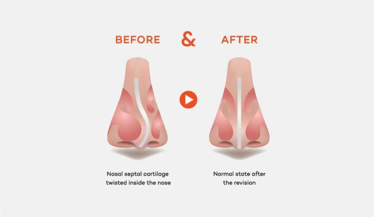Phẫu thuật xử lí lệch vách ngăn mũi kết hợp thẩm mỹ là gì? septal deviation rhinoplasty method 768x446 1